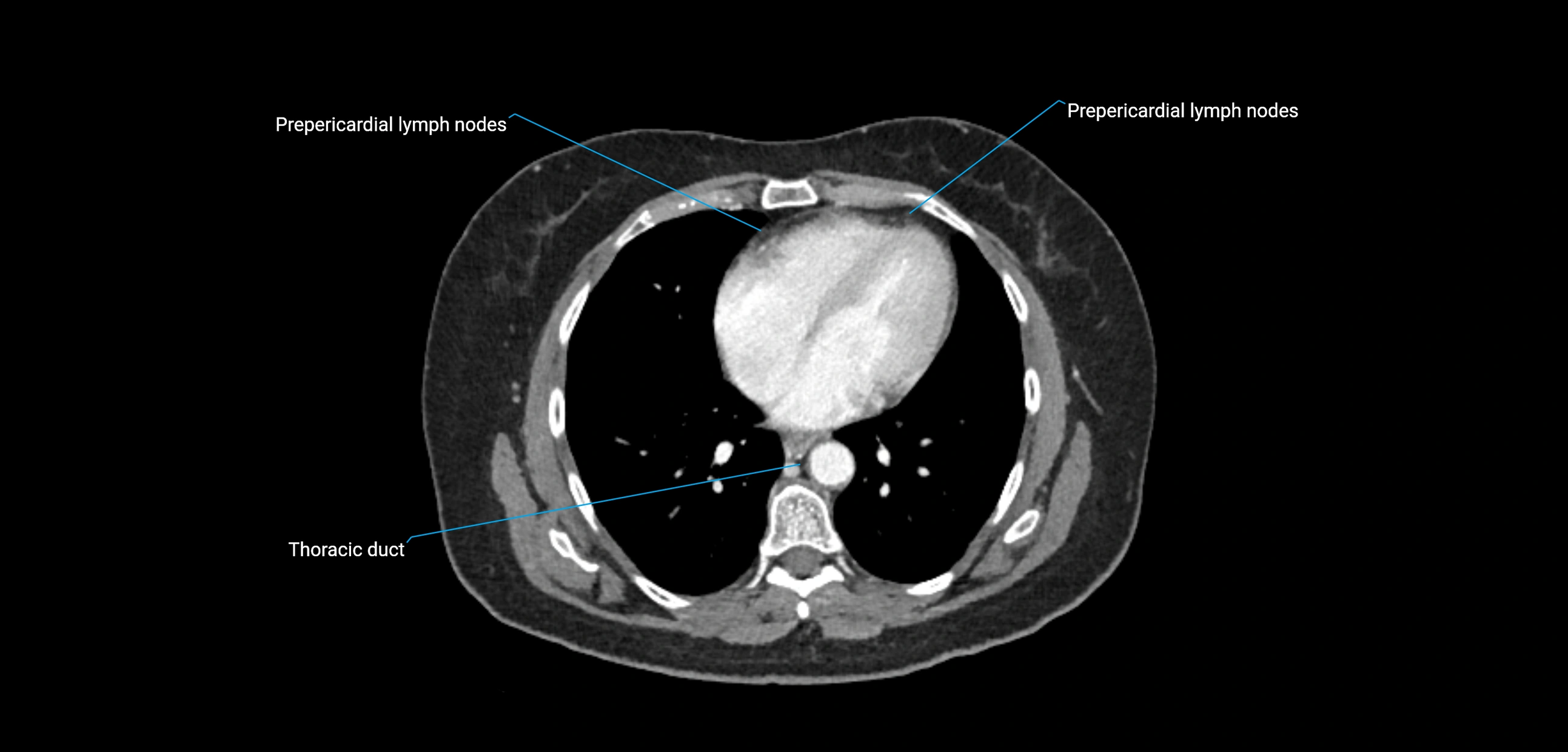 CT ct abdominal lymph nodes  axial cross sectional anatomy  enchanced radiology image -img-00002-00042.webp